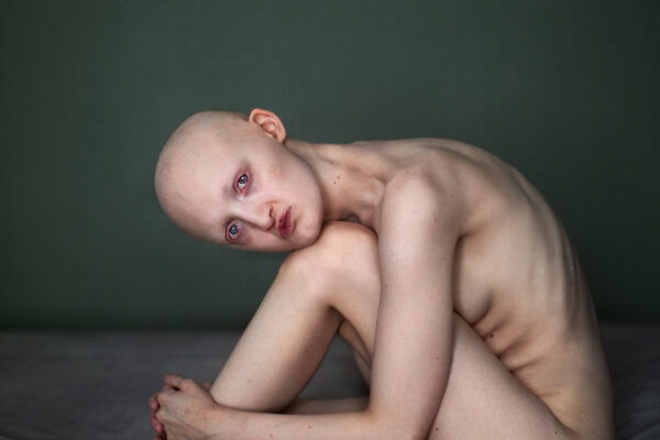 studio color portrait photograph of a girl with Hay-Wells Syndrome by Sujata Setia